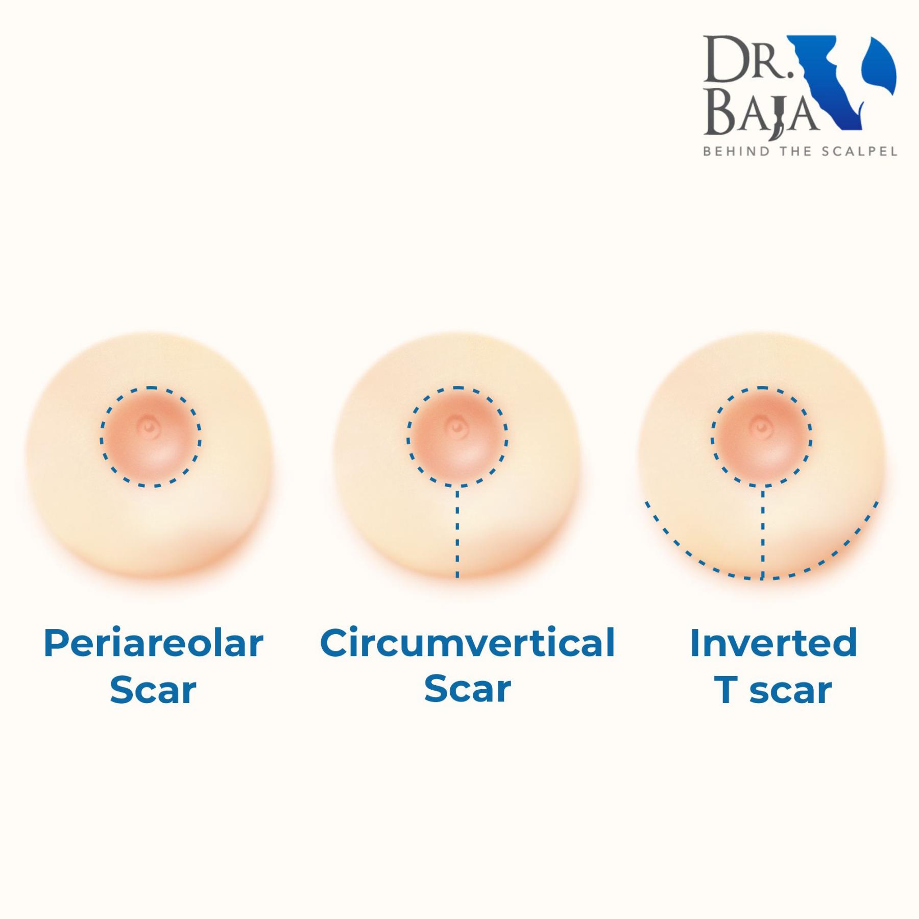 mastopexy scars